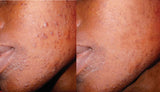 Oily Skin Cleanser  | Skin Cleanser | BAME Skincare