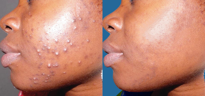 Oily Skin Cleanser  | Skin Cleanser | BAME Skincare