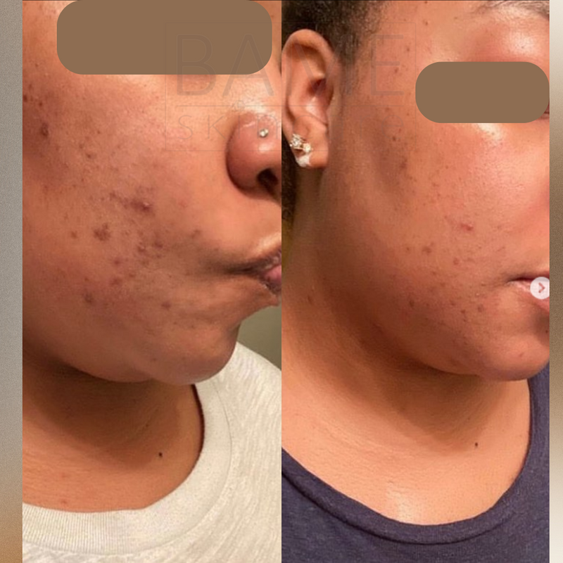 Acne and PIH treatment
